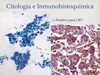 Citologia e Inmunohistoquimica
 Positivo para CK7
 