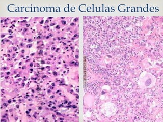 Carcinoma de Celulas Grandes
 