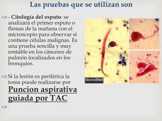 Las pruebas que se utilizan son
 - Citología del esputo: se
analizará el primer esputo o
flemas de la mañana con el
microscopio para observar si
contiene células malignas. Es
una prueba sencilla y muy
rentable en los cánceres de
pulmón localizados en los
bronquios.
 Si la lesión es periférica la
toma puede realizarse por
Puncion aspirativa
guiada por TAC

 
