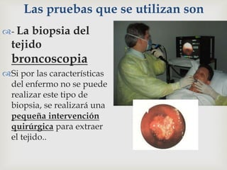 Las pruebas que se utilizan son
- La biopsia del
tejido
broncoscopia
Si por las características
del enfermo no se puede
realizar este tipo de
biopsia, se realizará una
pequeña intervención
quirúrgica para extraer
el tejido..
 