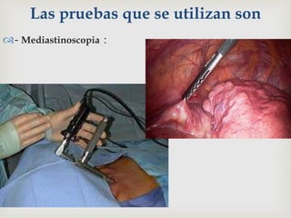 Las pruebas que se utilizan son
- Mediastinoscopia :
 