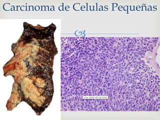 
Carcinoma de Celulas Pequeñas
 