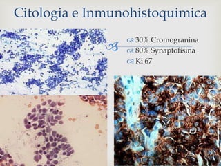 
 30% Cromogranina
 80% Synaptofisina
 Ki 67
Citologia e Inmunohistoquimica
 
