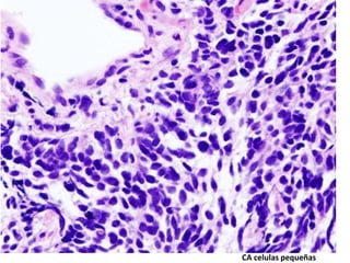 CA celulas pequeñas
 