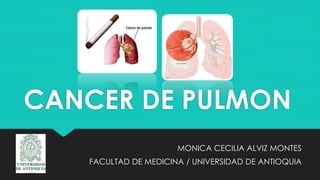 CANCER DE PULMON
MONICA CECILIA ALVIZ MONTES
FACULTAD DE MEDICINA / UNIVERSIDAD DE ANTIOQUIA
 