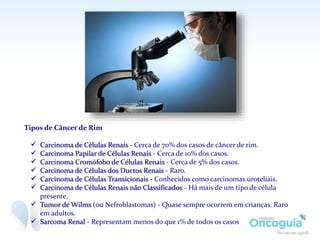 Tipos de Câncer de Rim
 Carcinoma de Células Renais - Cerca de 70% dos casos de câncer de rim.
 Carcinoma Papilar de Células Renais - Cerca de 10% dos casos.
 Carcinoma Cromófobo de Células Renais - Cerca de 5% dos casos.
 Carcinoma de Células dos Ductos Renais - Raro.
 Carcinoma de Células Transicionais - Conhecidos como carcinomas uroteliais.
 Carcinoma de Células Renais não Classificados - Há mais de um tipo de célula
presente.
 Tumor de Wilms (ou Nefroblastomas) - Quase sempre ocorrem em crianças. Raro
em adultos.
 Sarcoma Renal - Representam menos do que 1% de todos os casos
 