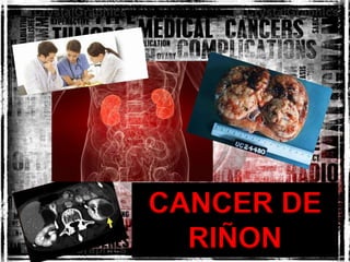CANCER DE
RIÑON
 