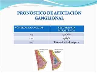 NÚMERO DE GANGLIOS RECURRENCIA METASTÁSICA 1-3 50-60% 4-10 75-85% > 10 Pronóstico incluso peor 