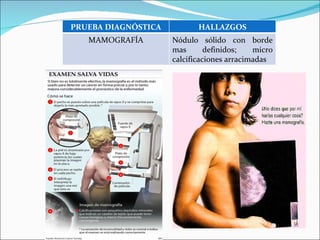 PRUEBA DIAGNÓSTICA HALLAZGOS MAMOGRAFÍA Nódulo sólido con borde mas definidos; micro calcificaciones arracimadas 