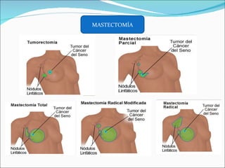 MASTECTOMÍA 