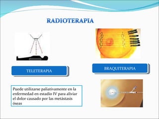 Puede utilizarse paliativamente en la enfermedad en estadio IV para aliviar el dolor causado por las metástasis óseas TELETERAPIA BRAQUITERAPIA 