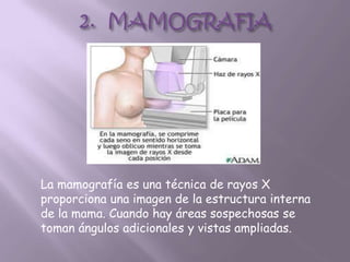 La mamografía es una técnica de rayos X
proporciona una imagen de la estructura interna
de la mama. Cuando hay áreas sospechosas se
toman ángulos adicionales y vistas ampliadas.
 
