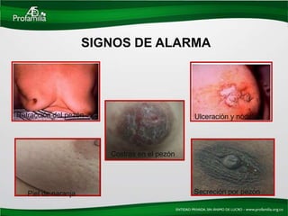 SIGNOS DE ALARMA




Retracción del pezón                          Ulceración y nódulos




                        Costras en el pezón




   Piel de naranja                            Secreción por pezón
 