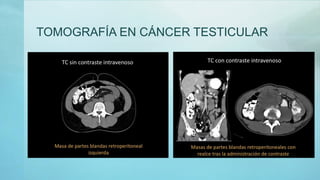 TOMOGRAFÍA EN CÁNCER TESTICULAR
 