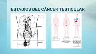 ESTADIOS DEL CÁNCER TESTICULAR
 