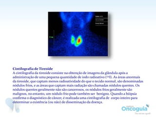 Cintilografia de Tireoide
A cintilografia da tireoide consiste na obtenção de imagens da glândula após a
administração de uma pequena quantidade de iodo radioativo (131I). As áreas anormais
da tireoide, que captam menos radioatividade do que o tecido normal, são denominadas
nódulos frios, e as áreas que captam mais radiação são chamadas nódulos quentes. Os
nódulos quentes geralmente não são cancerosos, os nódulos frios geralmente são
malignos, no entanto, um nódulo frio pode também ser benigno. Quando a biópsia
confirma o diagnóstico de câncer, é realizada uma cintilografia de corpo inteiro para
determinar a existência (ou não) de disseminação da doença.
 