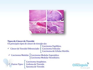Tipos de Câncer de Tireoide
Os principais tipos de câncer de tireoide são:
Carcinoma Papilífero.
 Câncer de Tireoide Diferenciado Carcinoma Folicular.
Carcinoma de Células Hürthle.
 Carcinoma Medular Carcinoma Medular Esporádico.
Carcinoma Medular Hereditário.
Carcinoma Anaplásico.
 Outros Tipos Linfoma de Tireoide.
Sarcoma de Tireoide.
 