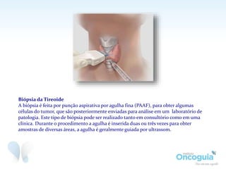 Biópsia da Tireoide
A biópsia é feita por punção aspirativa por agulha fina (PAAF), para obter algumas
células do tumor, que são posteriormente enviadas para análise em um laboratório de
patologia. Este tipo de biópsia pode ser realizado tanto em consultório como em uma
clínica. Durante o procedimento a agulha é inserida duas ou três vezes para obter
amostras de diversas áreas, a agulha é geralmente guiada por ultrassom.
 