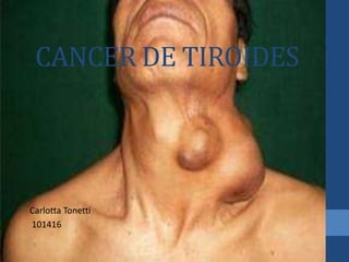 CANCER DE TIROIDES
Carlotta Tonetti
101416
 