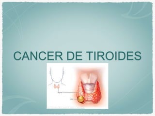 CANCER DE TIROIDES
 