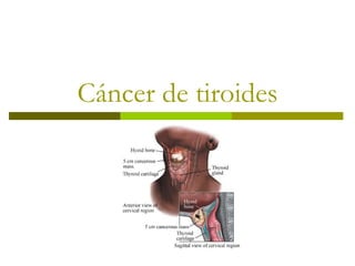 Cáncer de tiroides
 
