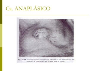 Ca. ANAPLÁSICO
 