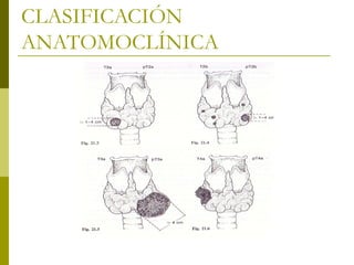 CLASIFICACIÓN
ANATOMOCLÍNICA
 