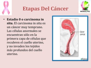 Etapas Del Cáncer Estadio 0 o carcinoma in situ.  El carcinoma in situ es un cáncer muy temprano. Las células anormales se encuentran sólo en la primera capa de células que recubren el cuello uterino, y no invaden los tejidos más profundos del cuello uterino. 
