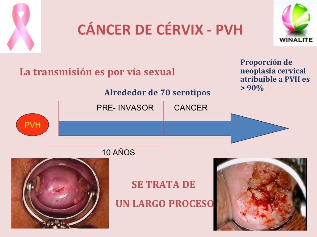 Cancer de utero (eli)