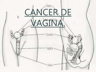 CANCER DE
VAGINA.
 