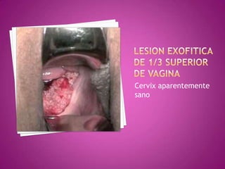 Cervix aparentemente
sano
 