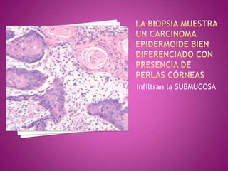 Infiltran la SUBMUCOSA
 