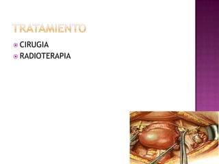  CIRUGIA
 RADIOTERAPIA
 
