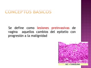 Se define como lesiones preinvasivas de
vagina aquellos cambios del epitelio con
progresión a la malignidad
 