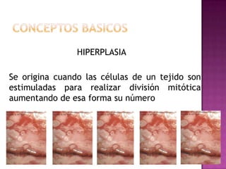 HIPERPLASIA

Se origina cuando las células de un tejido son
estimuladas para realizar división mitótica
aumentando de esa forma su número
 
