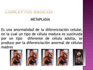METAPLASIA

Es una anormalidad de la diferenciación celular,
en la cual un tipo de célula madura es sustituida
por un tipo diferente de célula adulta, se
produce por la diferenciación anormal de células
madres
 