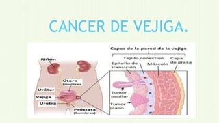 CANCER DE VEJIGA.
 