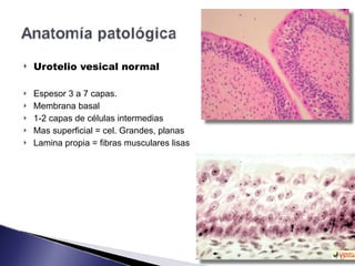 ! Urotelio vesical normal
! Espesor 3 a 7 capas.
! Membrana basal
! 1-2 capas de células intermedias
! Mas superficial = cel. Grandes, planas
! Lamina propia = fibras musculares lisas
 
