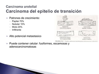 ! Patrones de crecimiento:
◦ Papilar 70%
◦ Nodular 10%
◦ Mixto 20%
◦ Infiltrante
! Alto potencial metastasico
! Puede contener celular: fusiformes, escamosas y
adenocarcinomatosas
 