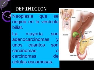 DEFINICION
Neoplasia que se
origina en la vesícula
biliar.
La      mayoría   son
adenocarcinomas y
unos cuantos son
carcinomas           o
carcinomas         de
células escamosas.
 