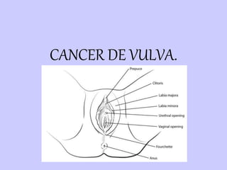 CANCER DE VULVA.
 