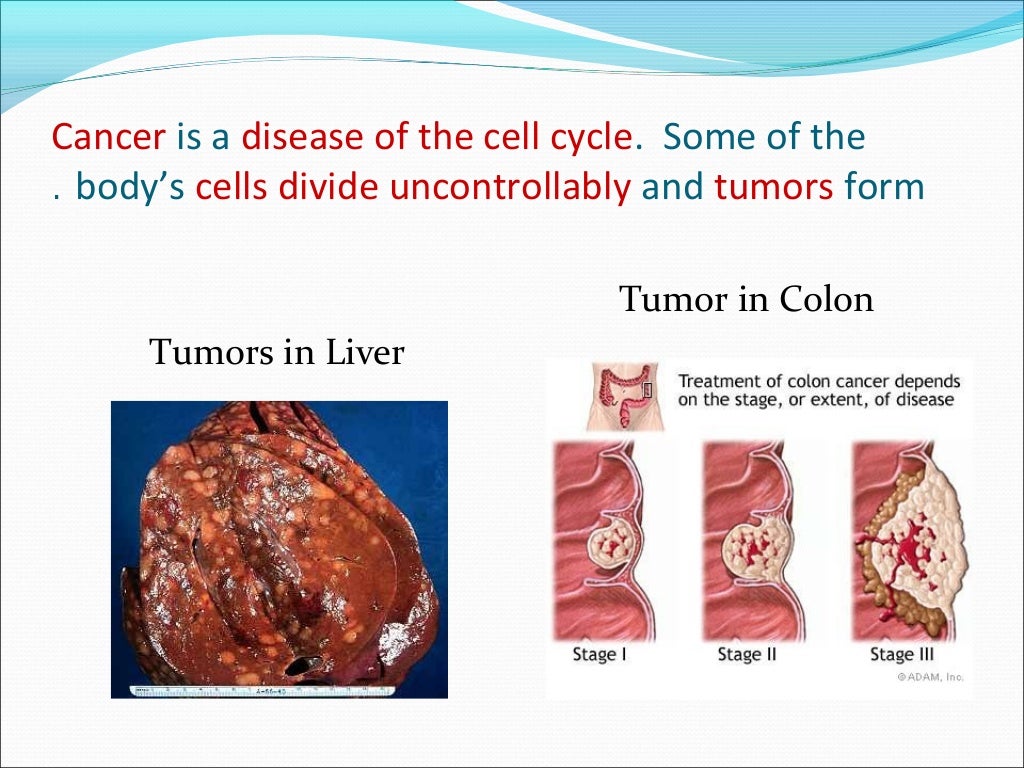 Cancer disease (2)