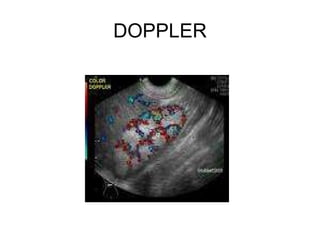DOPPLER 