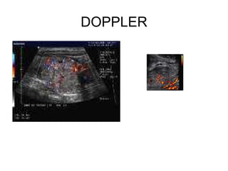 DOPPLER 