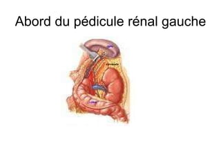Abord du pédicule rénal gauche 