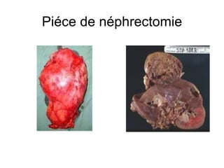 Piéce de néphrectomie 