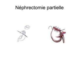 Néphrectomie partielle 