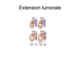 Extension tumorale 
