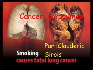  
 

Cancer  du poumon


      Par :Clauderic
      Sirois
 