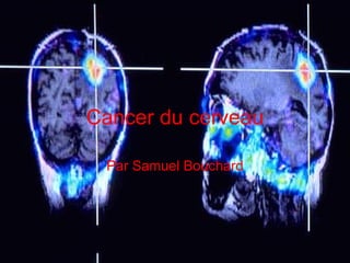 Cancer du cerveau

 Par Samuel Bouchard
 